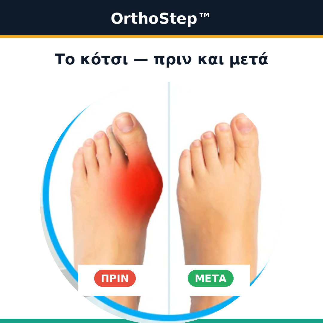 OrthoStep™ – Διορθωτής για το κότσι (βλαισό μέγα δάκτυλο) χωρίς χειρουργείο